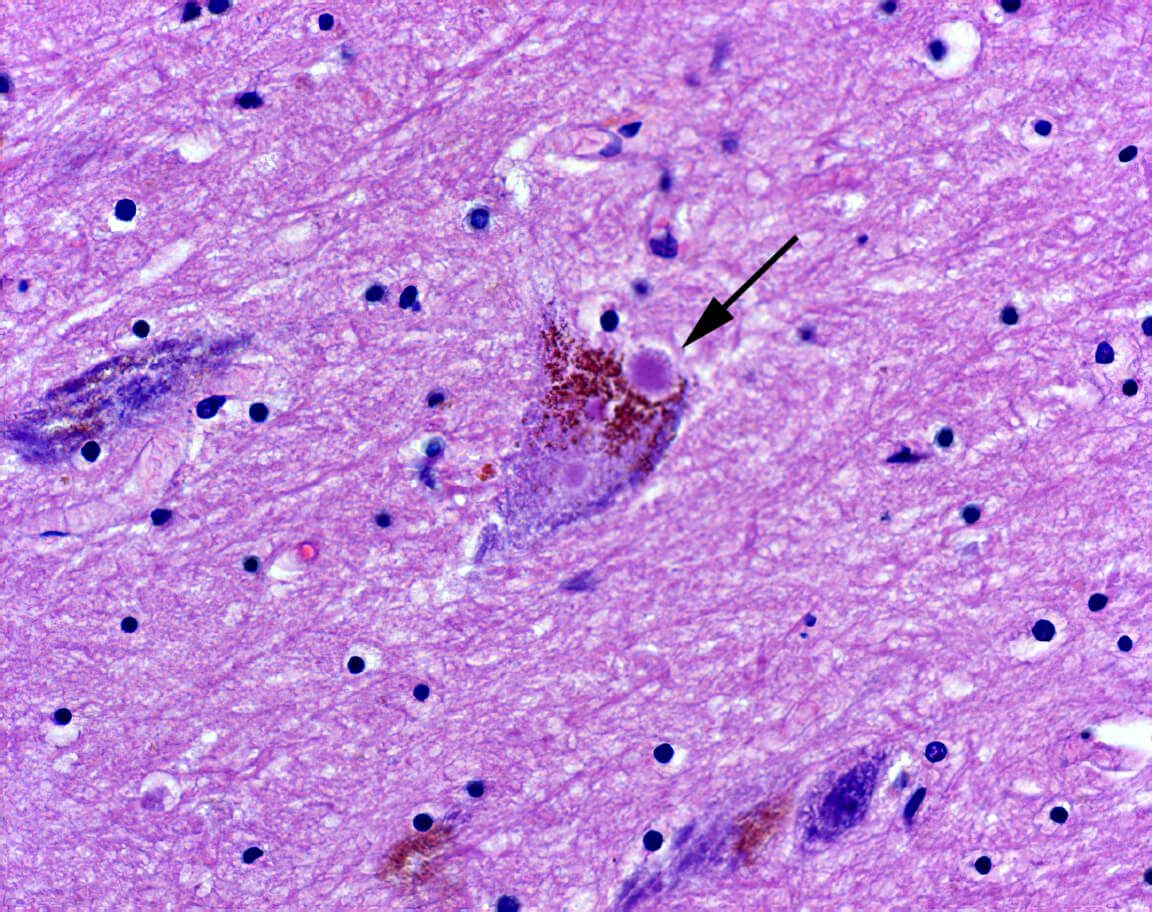 Neurons with pathological accumulations of Lewy bodies (shown by arrows)