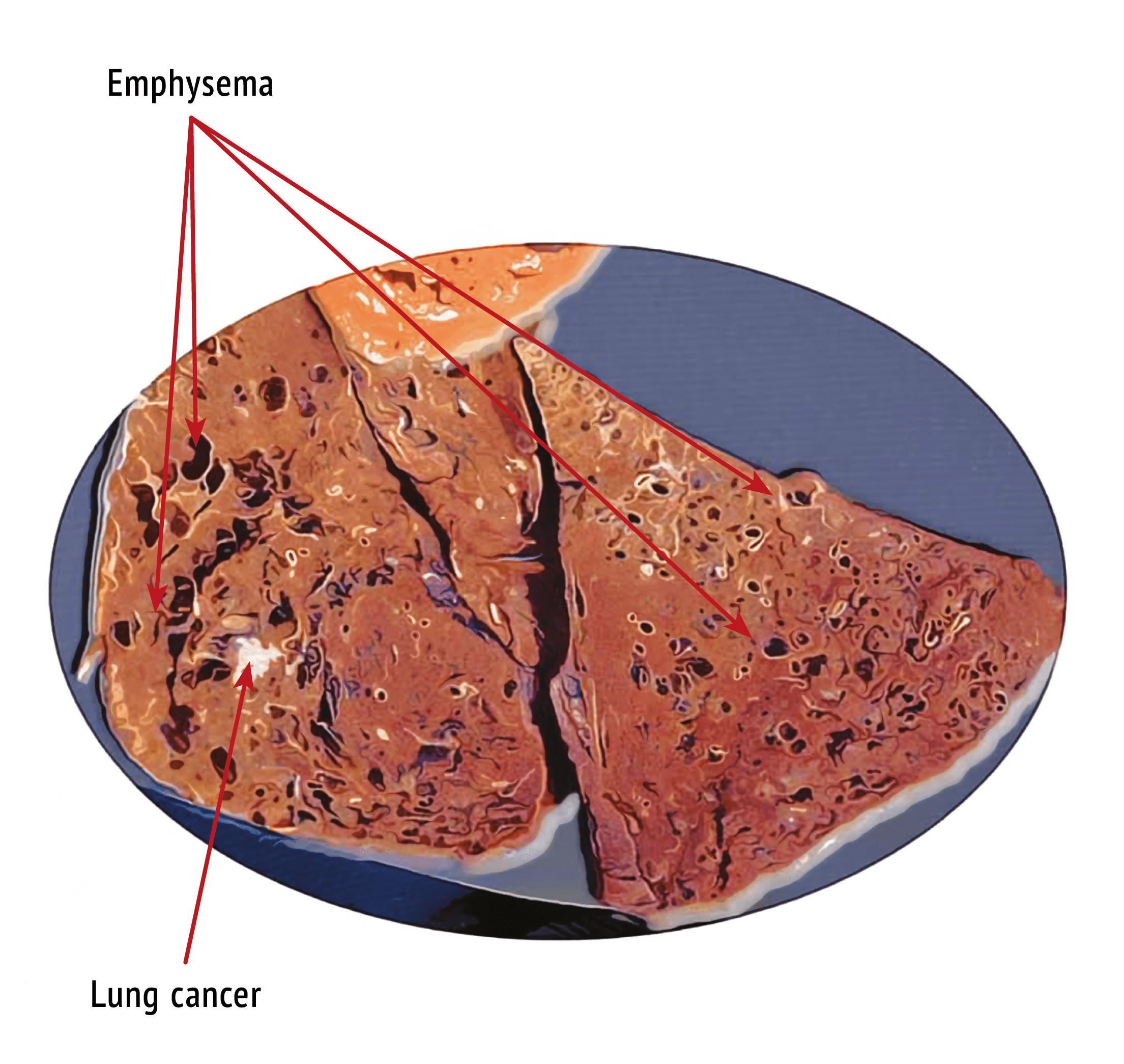 A model of fractal analysis in the diagnosis of lung cancer.