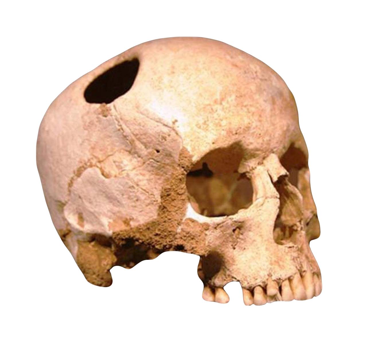 Medicine | A skull with a hole in it on a white background.